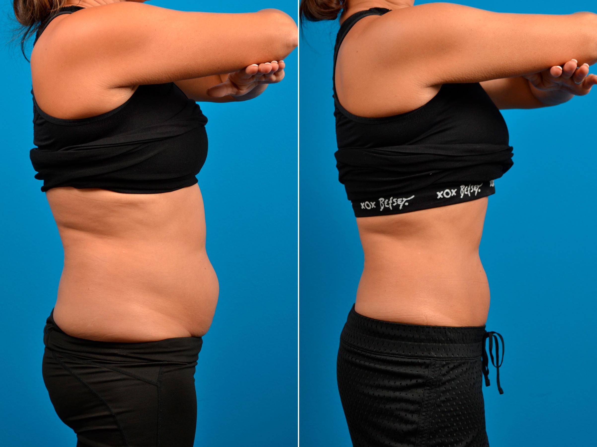 CoolSculpting Photos Melbourne FL Patient 59360
